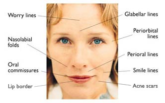 Restylane